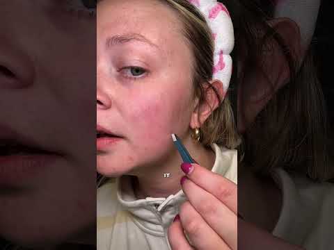 WHY I STOPPED POPPING PIMPLES AND STARTED USING PATCHES